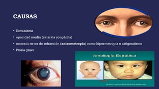CAUSAS
• Estrabismo
• opacidad media (catarata congénita)
• marcado error de refracción (anisometropía) como hipermetropía o astigmatismo
• Ptosis grave
 