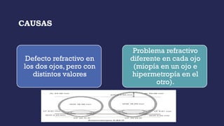 CAUSAS
Defecto refractivo en
los dos ojos, pero con
distintos valores
Problema refractivo
diferente en cada ojo
(miopía en un ojo e
hipermetropía en el
otro).
 