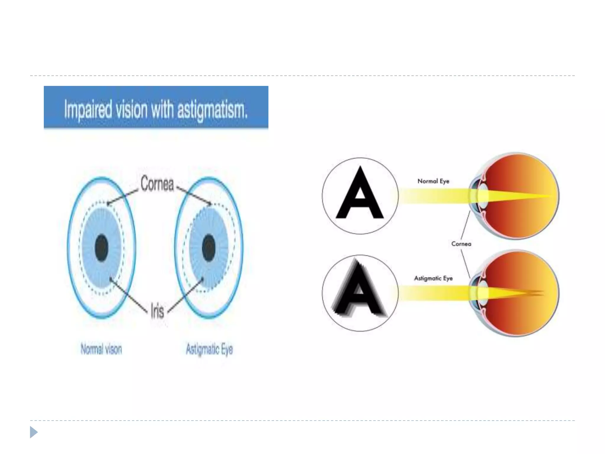Defects of eye | PPTX