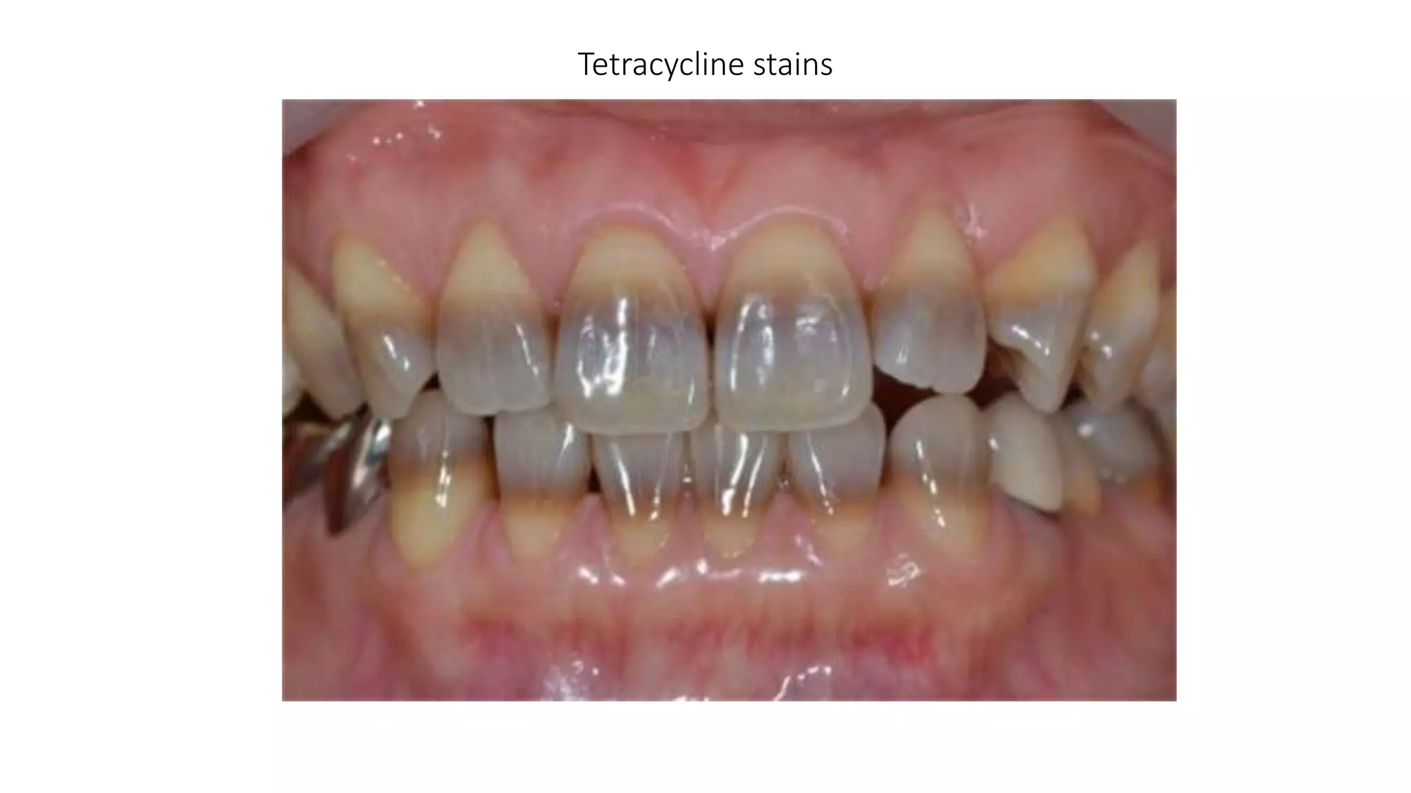 Tetracycline stains
 