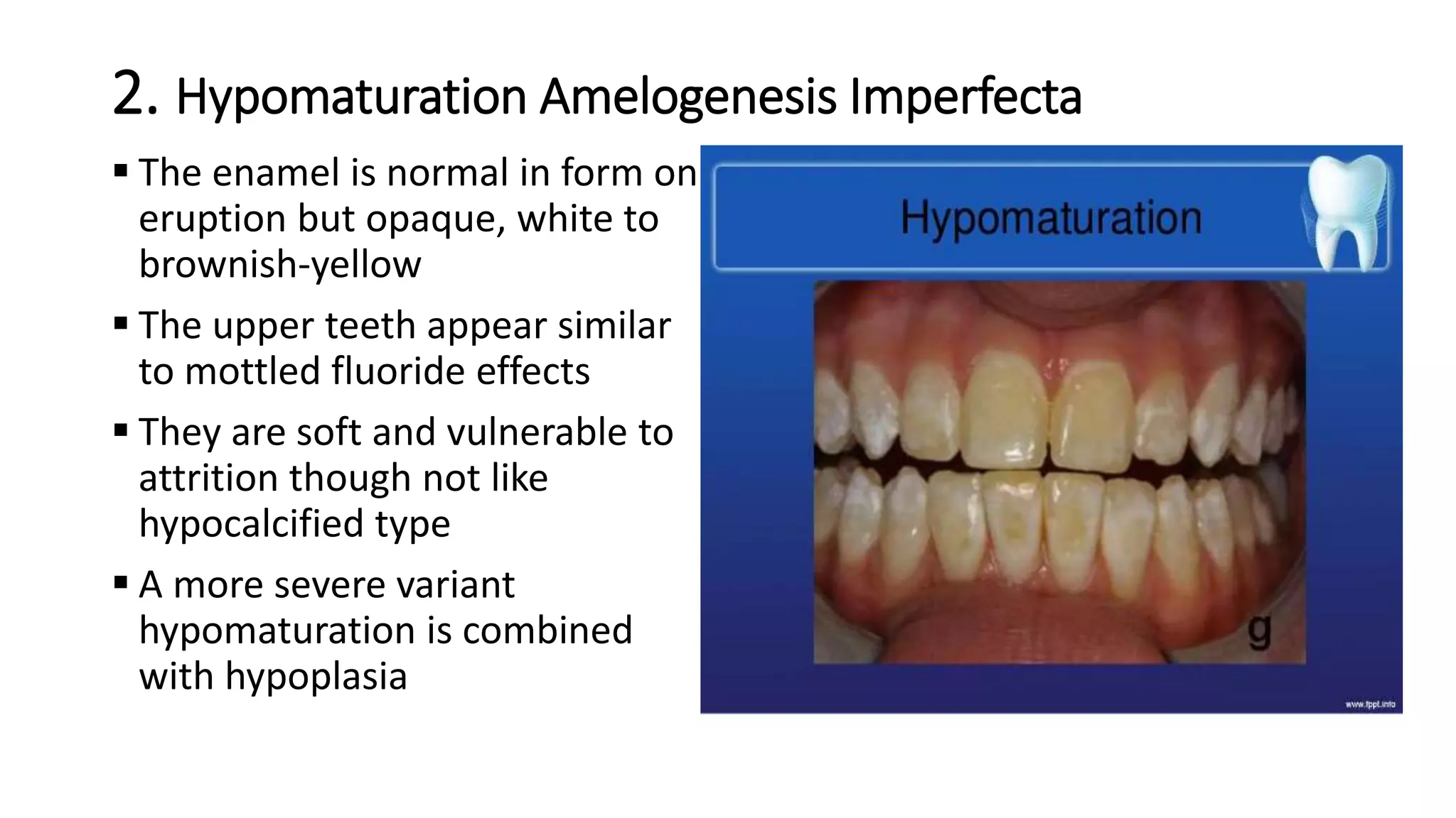 2. Hypomaturation Amelogenesis Imperfecta
 The enamel is normal in form on
eruption but opaque, white to
brownish-yellow
 The upper teeth appear similar
to mottled fluoride effects
 They are soft and vulnerable to
attrition though not like
hypocalcified type
 A more severe variant
hypomaturation is combined
with hypoplasia
 