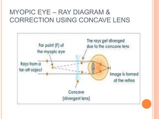 MYOPIC EYE – RAY DIAGRAM &
CORRECTION USING CONCAVE LENS
 
