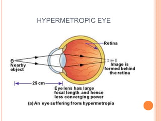 HYPERMETROPIC EYE
 