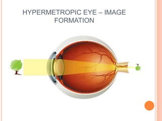 HYPERMETROPIC EYE – IMAGE
FORMATION
 