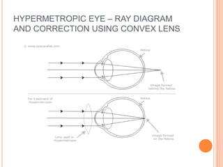 HYPERMETROPIC EYE – RAY DIAGRAM
AND CORRECTION USING CONVEX LENS
 
