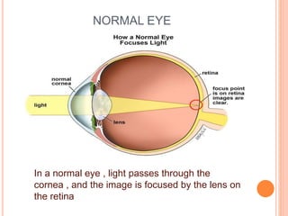 NORMAL EYE
In a normal eye , light passes through the
cornea , and the image is focused by the lens on
the retina
 