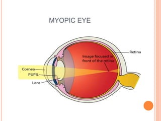 MYOPIC EYE
 