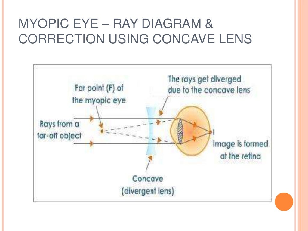 Defects Of Vision