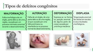 MELHOR para você
E M P R E S A D E O R G Â N I C O S
Tipos de defeitos congênitos
3
ALTERAÇÃO
Falha de um órgão, de uma
parte dele ou de uma região,
só que causado por uma
falha extrínseca ou
interferência no processo
normal do desenvolvimento;
DEFORMAÇÃO
Expressa-se na forma
ou posição anormal
de alguma parte do
corpo causada por
uma força mecânica
DISPLASIA
Organização anormal
de células em tecidos
e seus resultados
morfológicos.
MALFORMAÇÃO
Falha morfológica de um
órgão, parte dele ou de uma
região, causado por um
processo intrínseco anormal
durante o desenvolvimento;
 