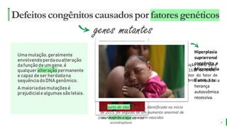 MELHOR para você
E M P R E S A D E O R G Â N I C O S
Defeitoscongênitoscausadospor fatoresgenéticos
Umamutação,geralmente
envolvendoperdaoualteração
dafunção deumgene,é
qualqueralteraçãopermanente
e capaz deser herdadana
sequênciadoDNAgenômico.
A maioriadasmutaçõesé
prejudicialealgumassão letais.
6
genes mutantes
Acondroplasia:
Mutação de transição de G para
A no nucleotídeo1138 do DNAc
no gene do receptor do fator de
crescimento de fibroblastos 3 no
cromossomo 4p.
O ator Peter Dinklage sofre de
acondroplasia
Hiperplasia
suprarrenal
congênita e
Microcefalia
É atribuída a
herança
autossômica
recessiva.
Um surto de zika no Brasil, identificado no início
de 2015, foi seguido de um aumento anormal de
microcefalia entre os recém-nascidos
 