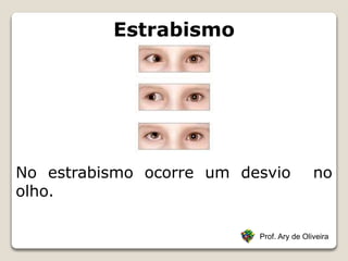 Estrabismo
Prof. Ary de Oliveira
No estrabismo ocorre um desvio no
olho.
 