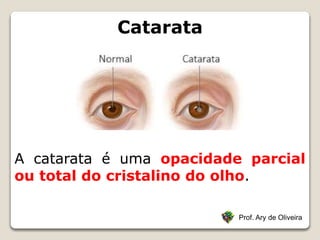 Catarata
Prof. Ary de Oliveira
A catarata é uma opacidade parcial
ou total do cristalino do olho.
 