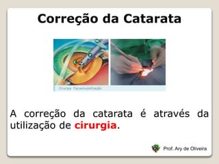 Correção da Catarata
Prof. Ary de Oliveira
A correção da catarata é através da
utilização de cirurgia.
 