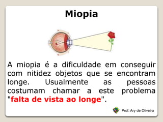 Miopia
Prof. Ary de Oliveira
A miopia é a dificuldade em conseguir
com nitidez objetos que se encontram
longe. Usualmente as pessoas
costumam chamar a este problema
"falta de vista ao longe".
 