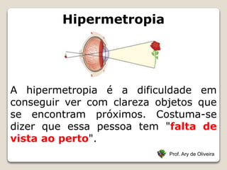 Hipermetropia
Prof. Ary de Oliveira
A hipermetropia é a dificuldade em
conseguir ver com clareza objetos que
se encontram próximos. Costuma-se
dizer que essa pessoa tem "falta de
vista ao perto".
 