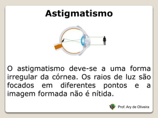 Astigmatismo
Prof. Ary de Oliveira
O astigmatismo deve-se a uma forma
irregular da córnea. Os raios de luz são
focados em diferentes pontos e a
imagem formada não é nítida.
 