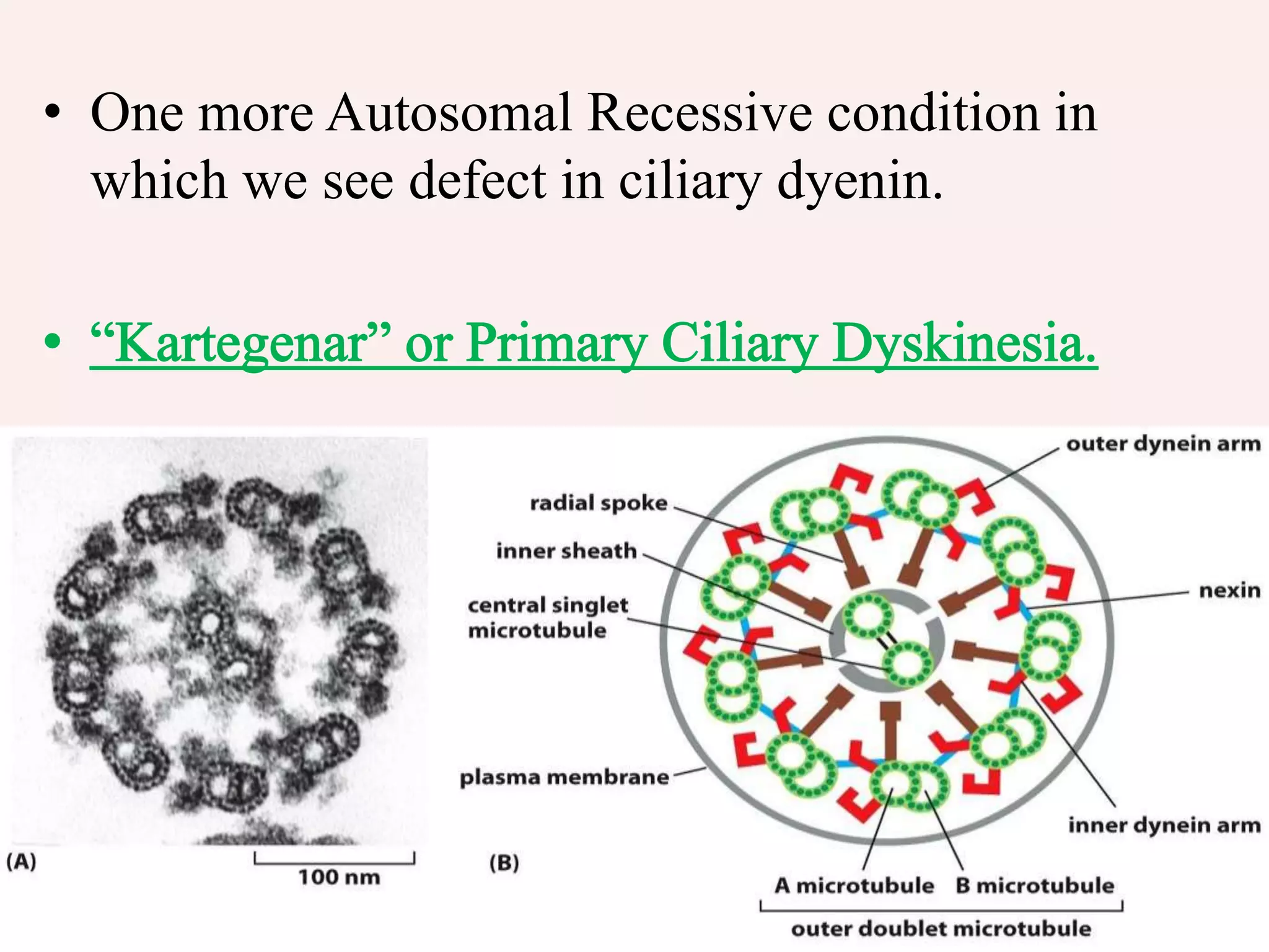 • One more Autosomal Recessive condition in
which we see defect in ciliary dyenin.
 