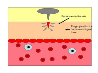 Bacteria enter the skin Phagocytes find the bacteria and ingest them. 