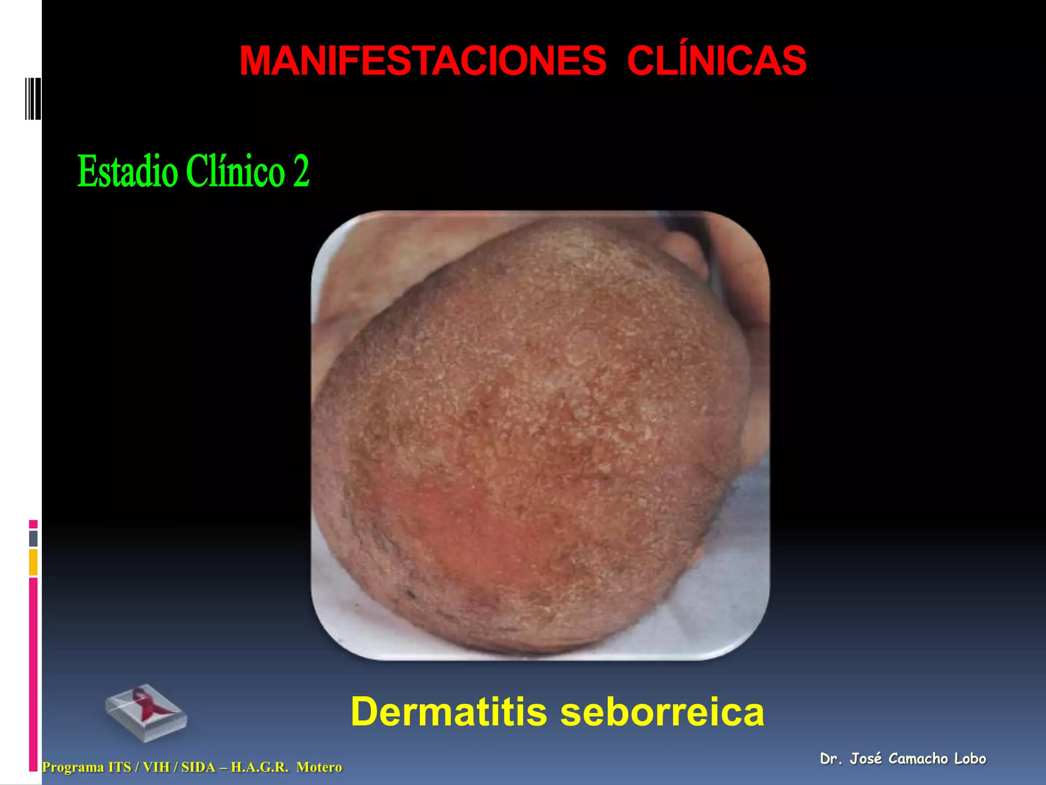 MANIFESTACIONES CLÍNICAS




                                              Dermatitis seborreica
                                                                      Dr. José Camacho Lobo
Programa ITS / VIH / SIDA – H.A.G.R. Motero
 