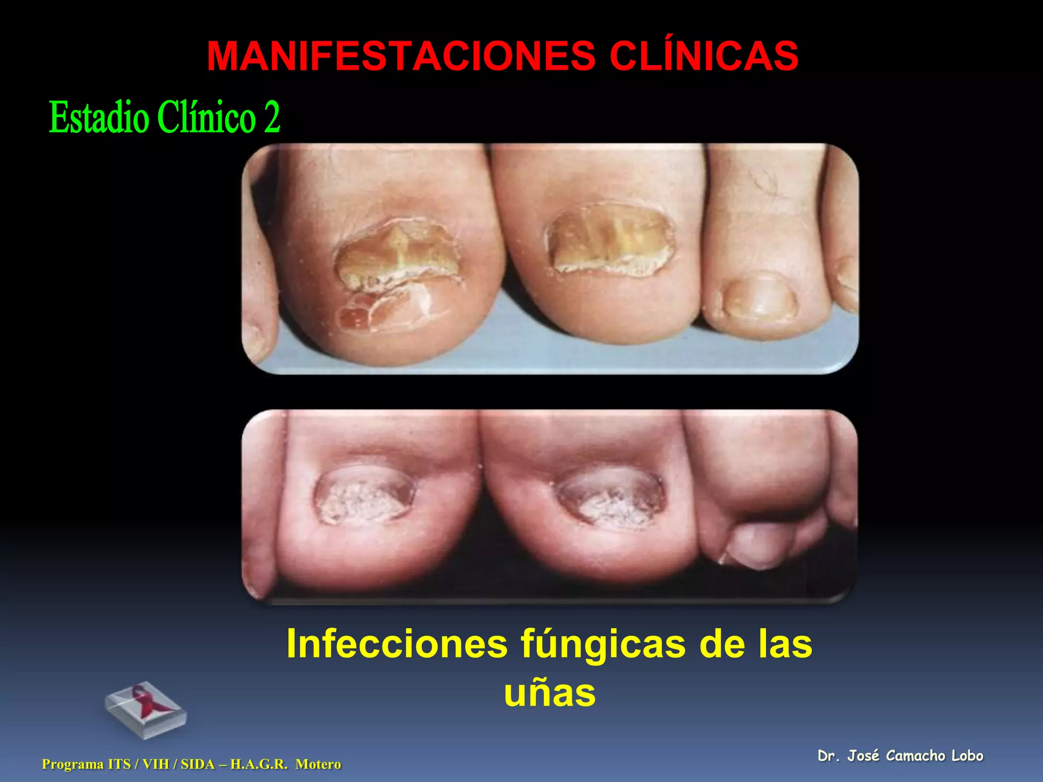 MANIFESTACIONES CLÍNICAS




                                   Infecciones fúngicas de las
                                              uñas
                                                                 Dr. José Camacho Lobo
Programa ITS / VIH / SIDA – H.A.G.R. Motero
 