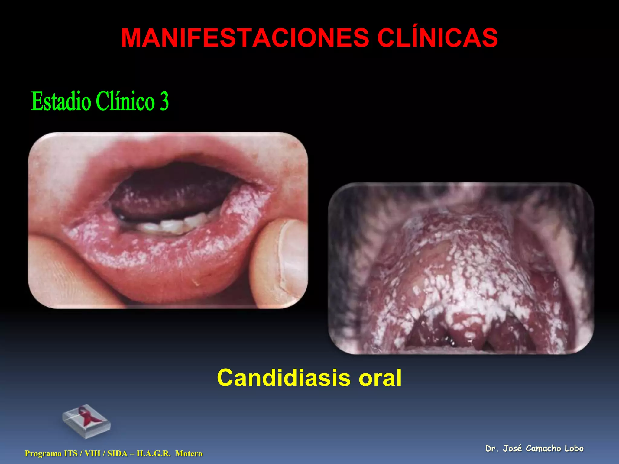 MANIFESTACIONES CLÍNICAS




                                              Candidiasis oral

                                                                 Dr. José Camacho Lobo
Programa ITS / VIH / SIDA – H.A.G.R. Motero
 