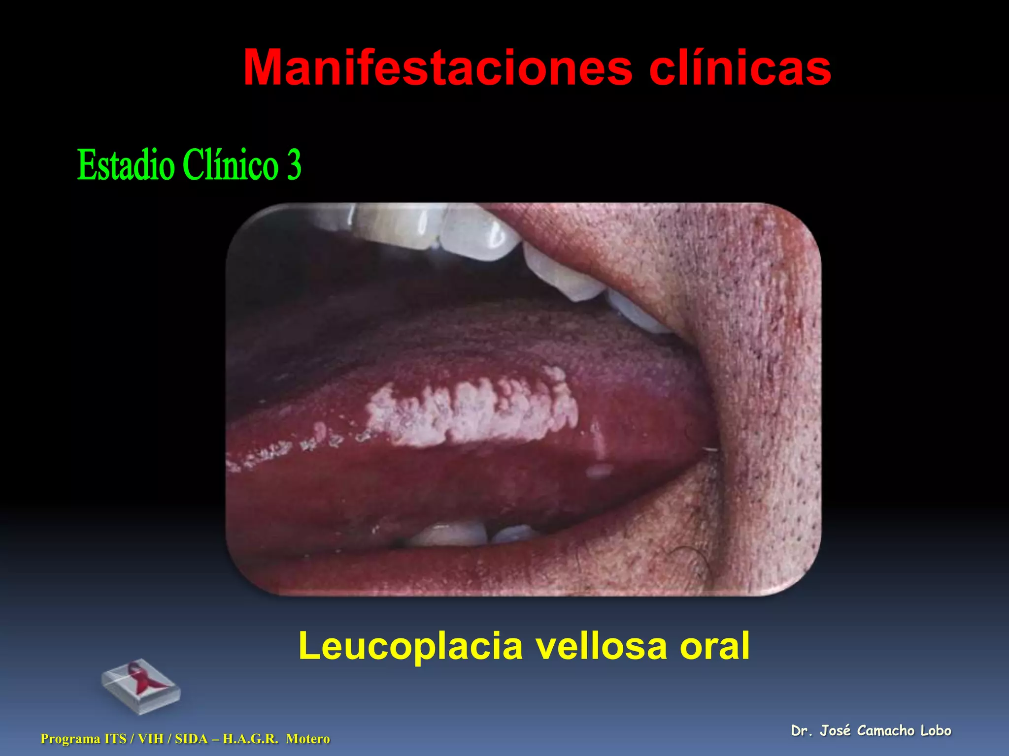 Manifestaciones clínicas




                                      Leucoplacia vellosa oral
                                                                 Dr. José Camacho Lobo
Programa ITS / VIH / SIDA – H.A.G.R. Motero
 