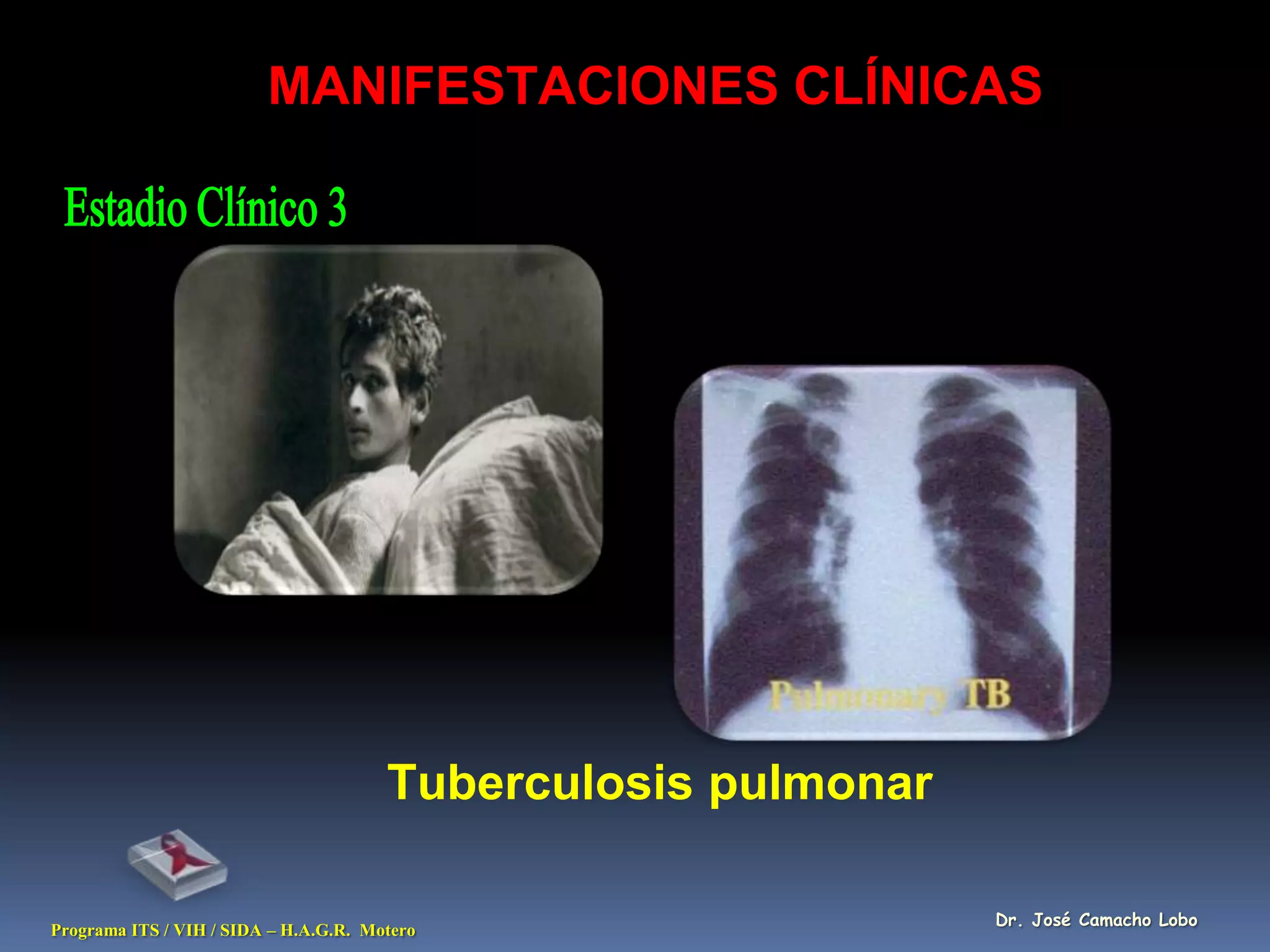 MANIFESTACIONES CLÍNICAS




                                       Tuberculosis pulmonar

                                                               Dr. José Camacho Lobo
Programa ITS / VIH / SIDA – H.A.G.R. Motero
 