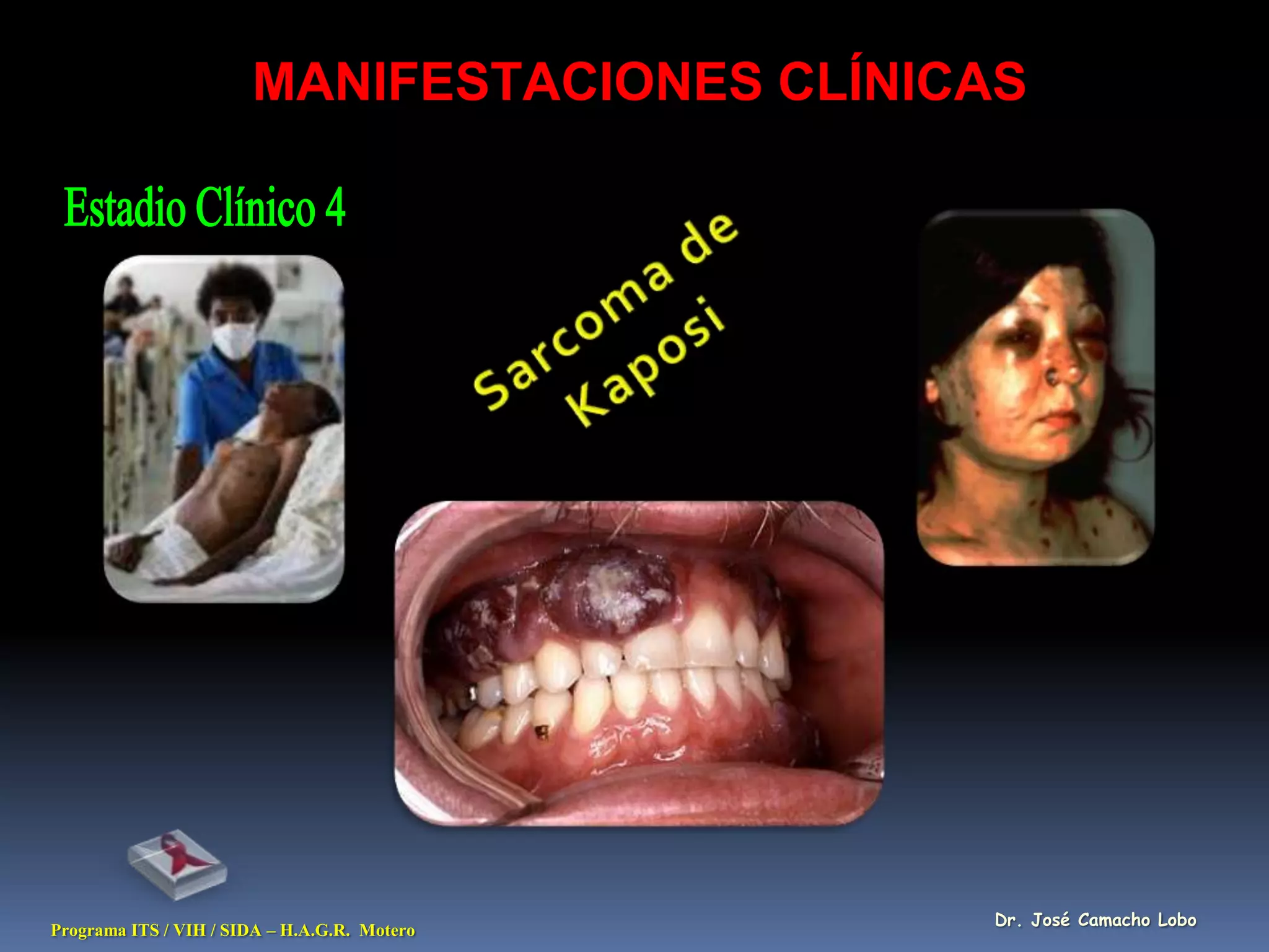 MANIFESTACIONES CLÍNICAS




                                              Dr. José Camacho Lobo
Programa ITS / VIH / SIDA – H.A.G.R. Motero
 