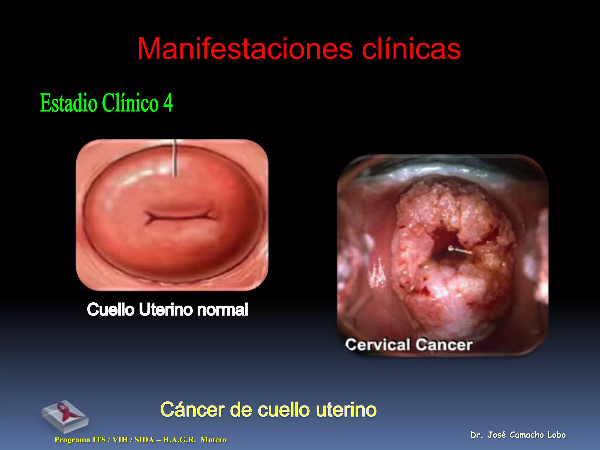 Manifestaciones clínicas




                                               Dr. José Camacho Lobo
Programa ITS / VIH / SIDA – H.A.G.R. Motero
 