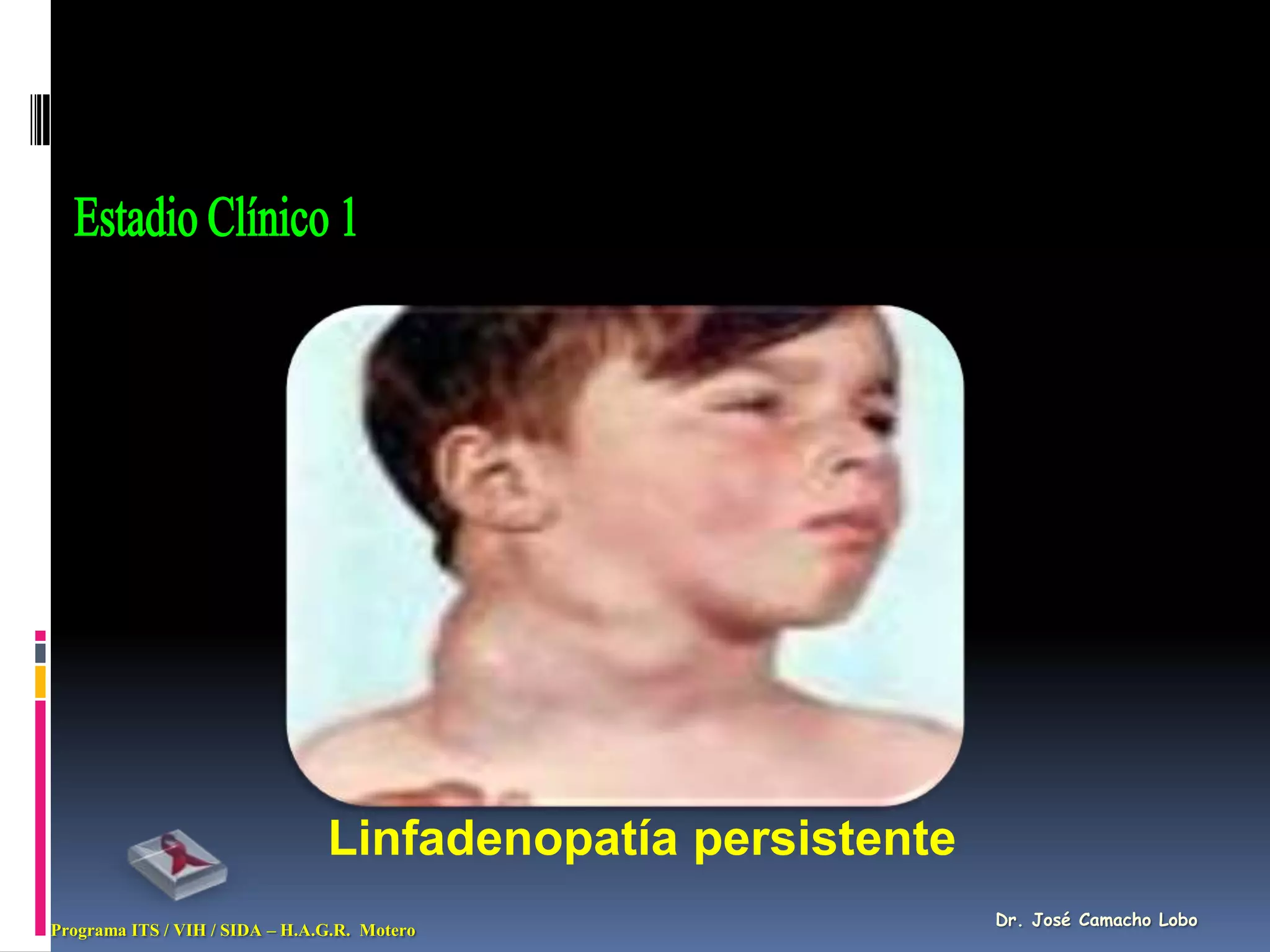 Linfadenopatía persistente
                                                             Dr. José Camacho Lobo
Programa ITS / VIH / SIDA – H.A.G.R. Motero
 