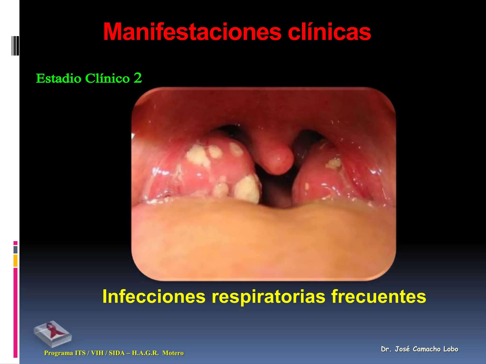 Manifestaciones clínicas




                 Infecciones respiratorias frecuentes

                                               Dr. José Camacho Lobo
Programa ITS / VIH / SIDA – H.A.G.R. Motero
 