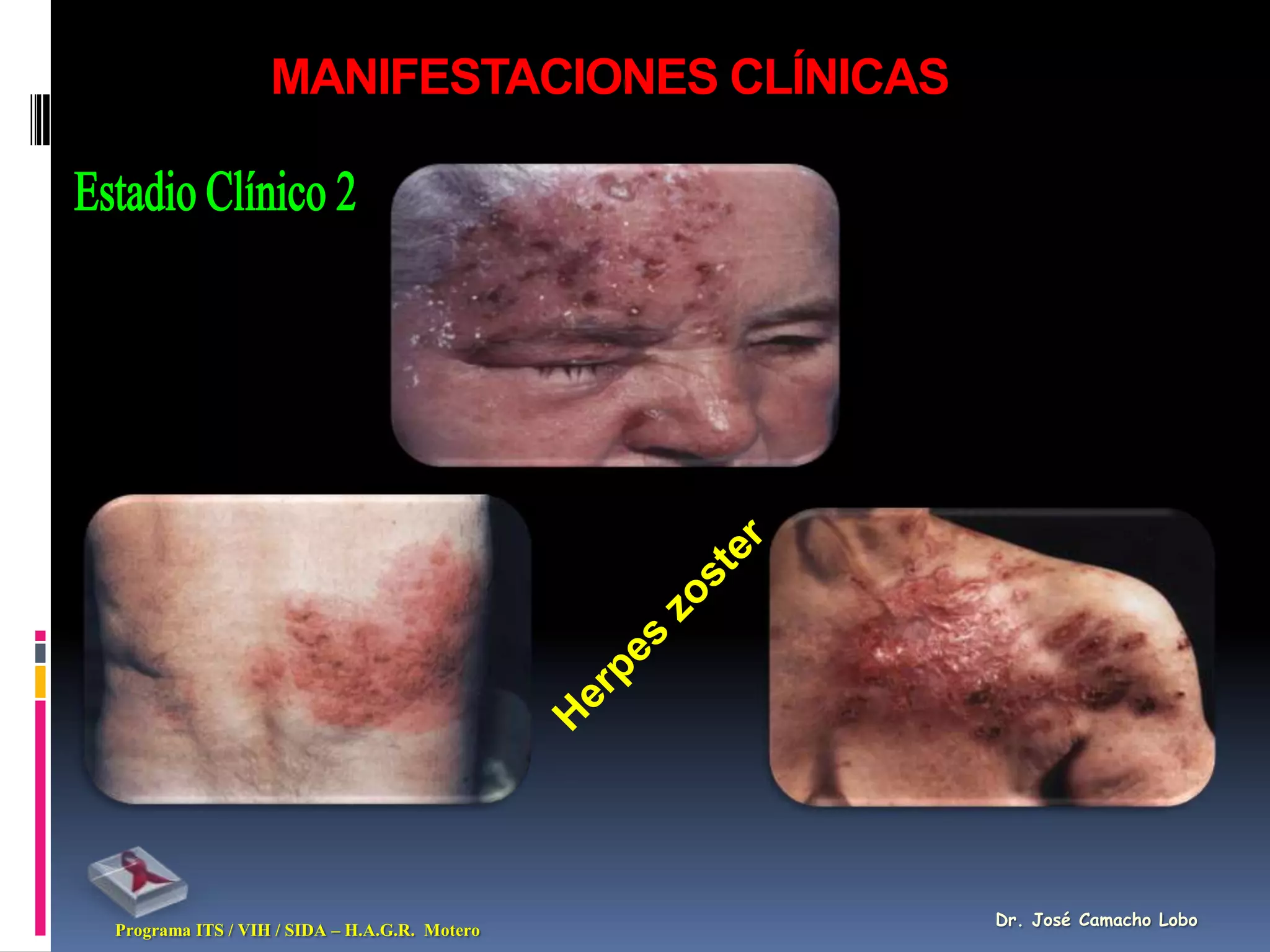 MANIFESTACIONES CLÍNICAS




                                              Dr. José Camacho Lobo
Programa ITS / VIH / SIDA – H.A.G.R. Motero
 