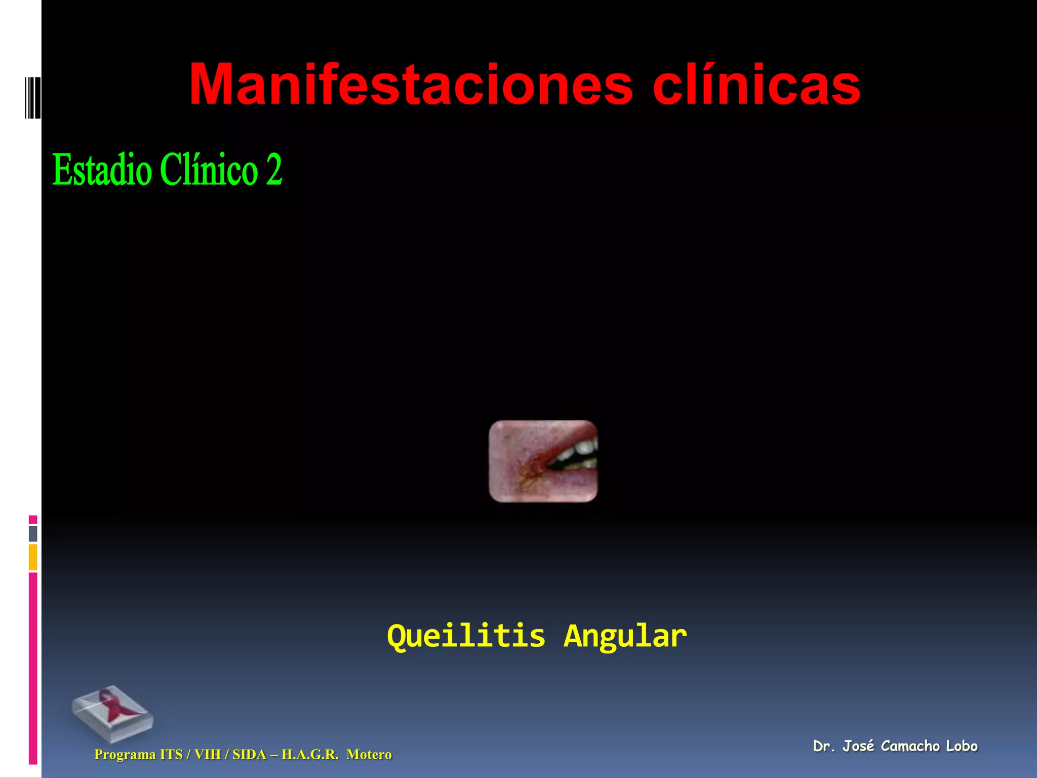 Manifestaciones clínicas




                                          Queilitis Angular


                                                              Dr. José Camacho Lobo
Programa ITS / VIH / SIDA – H.A.G.R. Motero
 