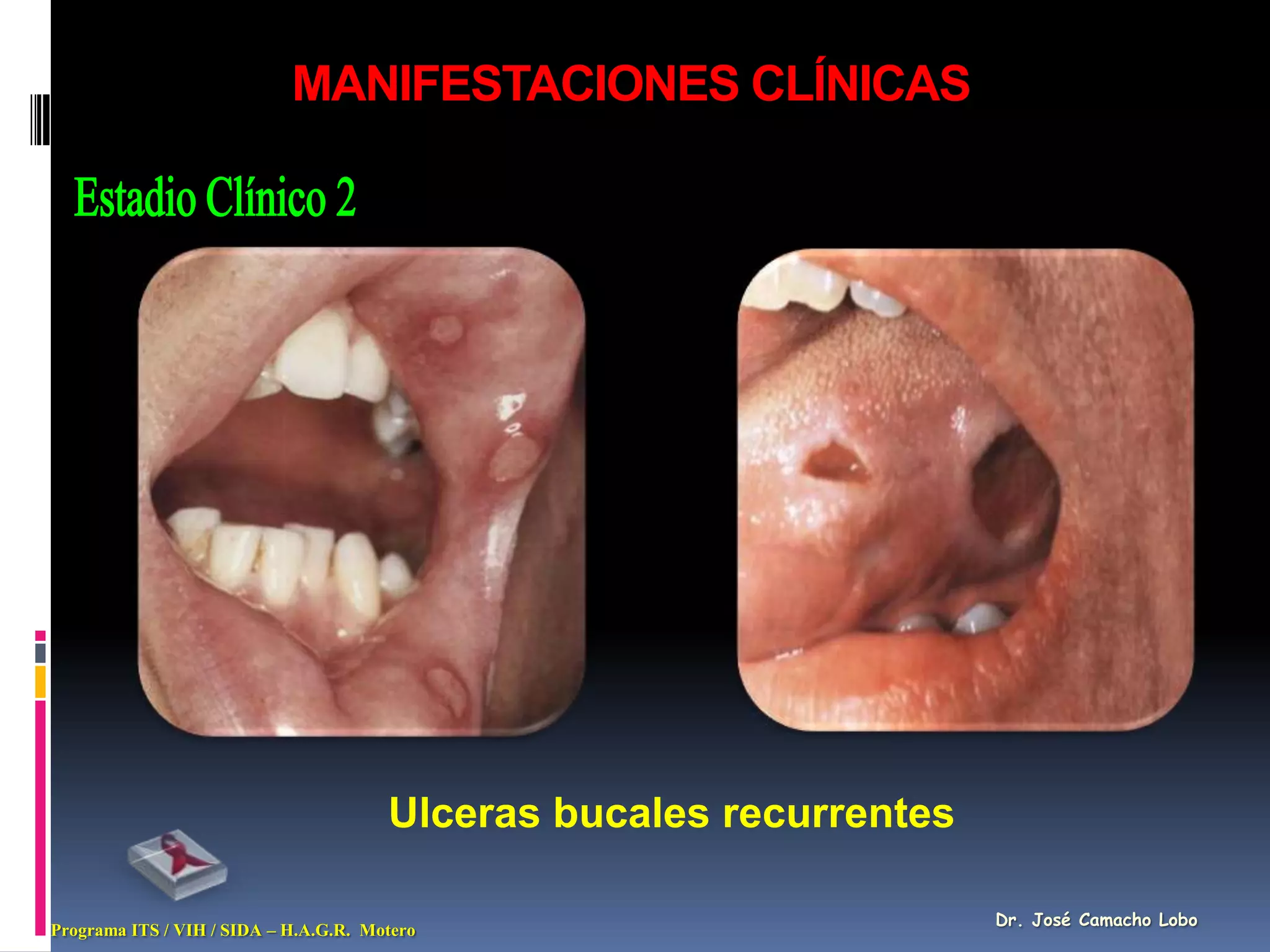 MANIFESTACIONES CLÍNICAS




                                       Ulceras bucales recurrentes

                                                                     Dr. José Camacho Lobo
Programa ITS / VIH / SIDA – H.A.G.R. Motero
 