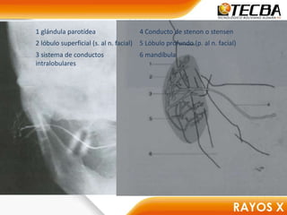 1 glándula parotídea 4 Conducto de stenon o stensen
2 lóbulo superficial (s. al n. facial) 5 Lóbulo profundo (p. al n. facial)
3 sistema de conductos
intralobulares
6 mandíbula
 