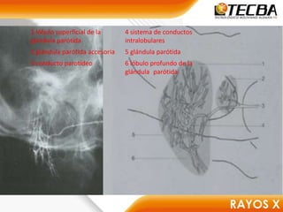 1 lóbulo superficial de la
glándula parótida
4 sistema de conductos
intralobulares
2 glándula parótida accesoria 5 glándula parótida
3 conducto parotídeo 6 lóbulo profundo de la
glándula parótida
 