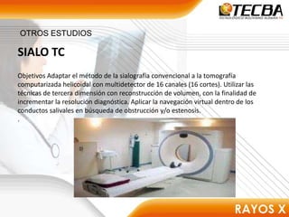 SIALO TC
.
OTROS ESTUDIOS
Objetivos Adaptar el método de la sialografía convencional a la tomografía
computarizada helicoidal con multidetector de 16 canales (16 cortes). Utilizar las
técnicas de tercera dimensión con reconstrucción de volumen, con la finalidad de
incrementar la resolución diagnóstica. Aplicar la navegación virtual dentro de los
conductos salivales en búsqueda de obstrucción y/o estenosis.
.
 