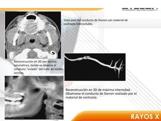 Vista axial del conducto de Stenon con material de
contraste hidrosoluble.
Reconstrucción en 3D con técnica
volumétrica, donde se observa el
conducto “aislado” del resto de tejidos
vecinos.
Reconstrucción en 3D de máxima intensidad.
Obsérvese el conducto de Stenon realzado por el
material de contraste.
 