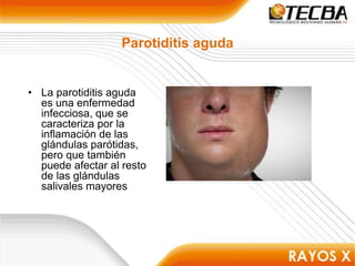 Parotiditis aguda
• La parotiditis aguda
es una enfermedad
infecciosa, que se
caracteriza por la
inflamación de las
glándulas parótidas,
pero que también
puede afectar al resto
de las glándulas
salivales mayores
 