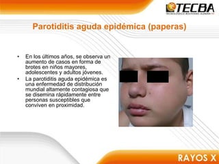 Parotiditis aguda epidémica (paperas)
• En los últimos años, se observa un
aumento de casos en forma de
brotes en niños mayores,
adolescentes y adultos jóvenes.
• La parotiditis aguda epidémica es
una enfermedad de distribución
mundial altamente contagiosa que
se disemina rápidamente entre
personas susceptibles que
conviven en proximidad.
 
