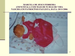 MARCELA DE JESUS FERREIRA ANENCÉFALA COM MAIS DE 91 DIAS DE VIDA NASCIDA EM PATROCÍNIO PAULISTA. DATA: 20/11/2006 