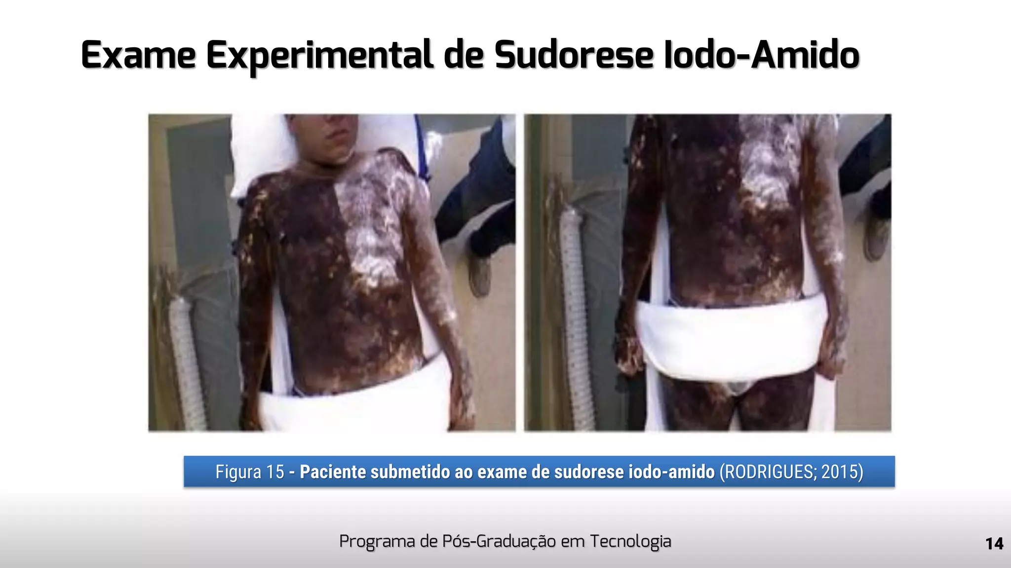 Exame Experimental de Sudorese Iodo-Amido
Programa de Pós-Graduação em Tecnologia 14
Figura 15 - Paciente submetido ao exame de sudorese iodo-amido (RODRIGUES; 2015)
 
