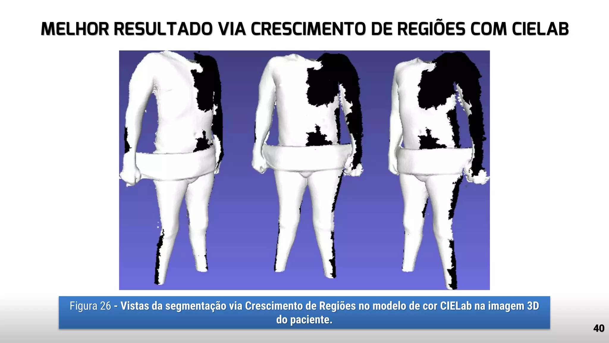 MELHOR RESULTADO VIA CRESCIMENTO DE REGIÕES COM CIELAB
40
Figura 26 - Vistas da segmentação via Crescimento de Regiões no modelo de cor CIELab na imagem 3D
do paciente.
 