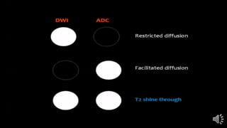 MRI Diffusion | PPTX