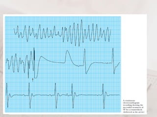 Defibrillator & cardioversion | PDF