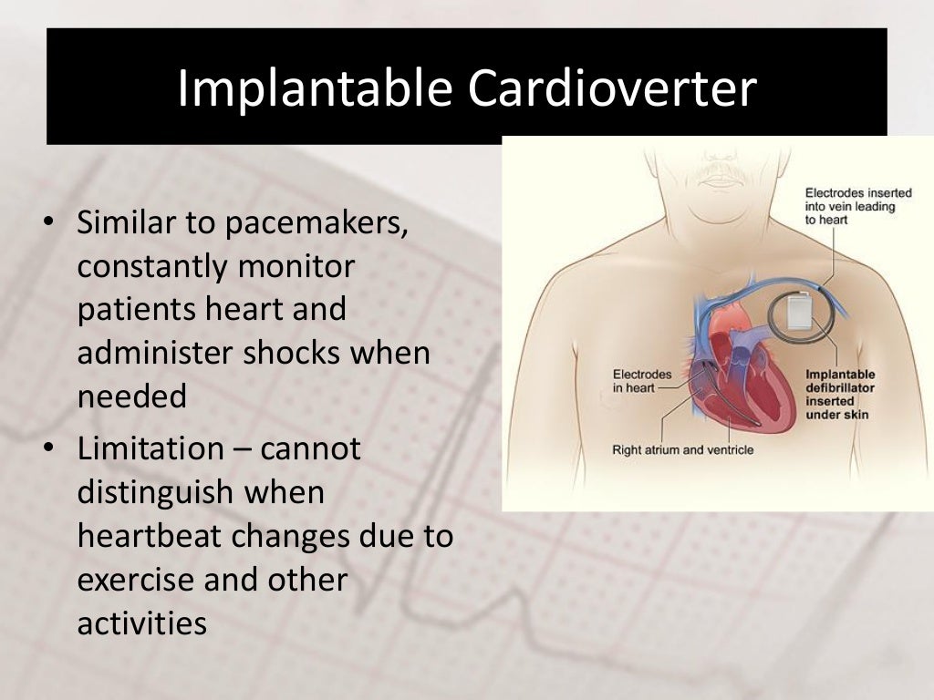 Defibrillator & cardioversion
