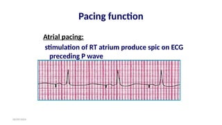 06/09/2024
Pacing function
Atrial pacing:
stimulation of RT atrium produce spic on ECG
preceding P wave
 