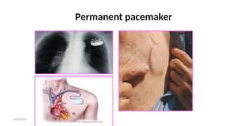 06/09/2024
Permanent pacemaker
 