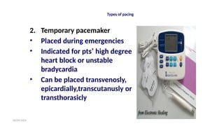 06/09/2024
Types of pacing
2. Temporary pacemaker
• Placed during emergencies
• Indicated for pts’ high degree
heart block or unstable
bradycardia
• Can be placed transvenosly,
epicardially,transcutanusly or
transthorasicly
 