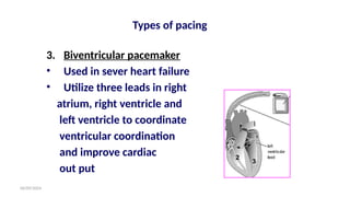 06/09/2024
3. Biventricular pacemaker
• Used in sever heart failure
• Utilize three leads in right
atrium, right ventricle and
left ventricle to coordinate
ventricular coordination
and improve cardiac
out put
Types of pacing
 